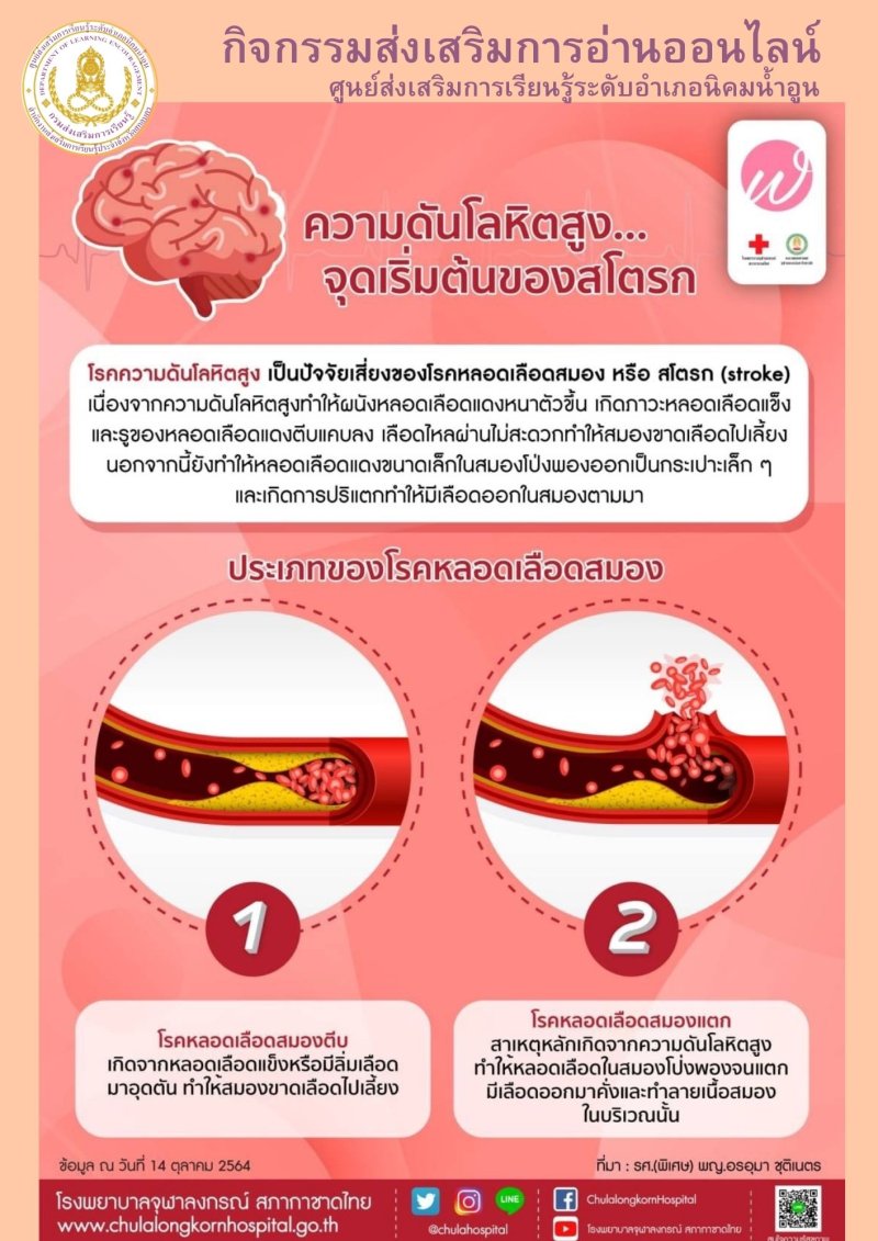 ความดันโลหิตสูงเริ่มต้นโรคสโตรก