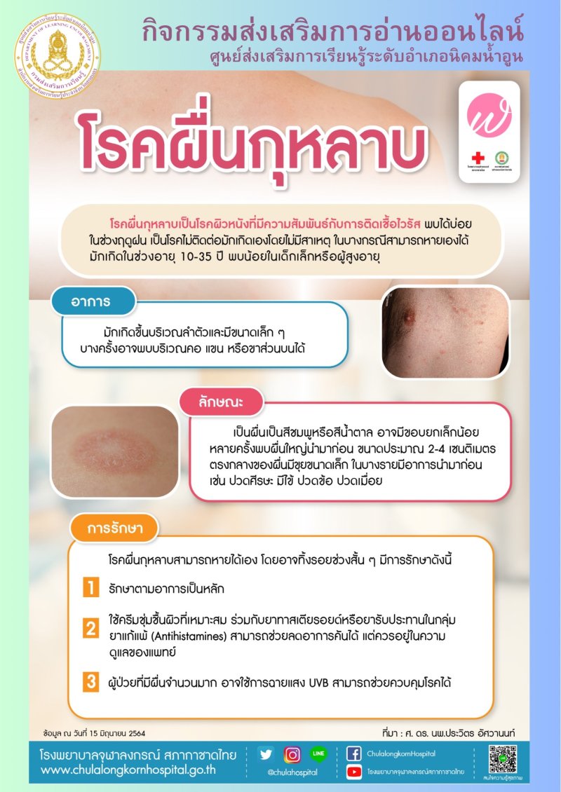 โรคผื่นกุหลาบ